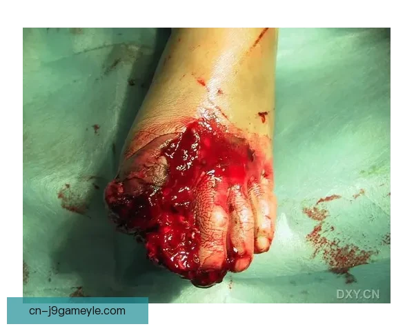 格里利什足部手术赛季报销确定